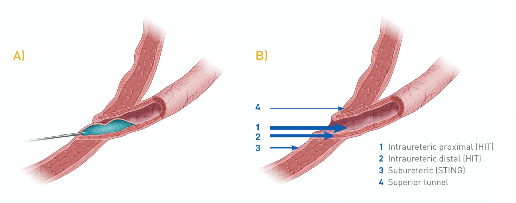 Double-HIT-Technique_graphic-1-1024x403
